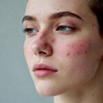how to remove pimples naturally and permanently