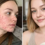 Why Am I Getting Sudden Cystic Acne? Causes & Treatment